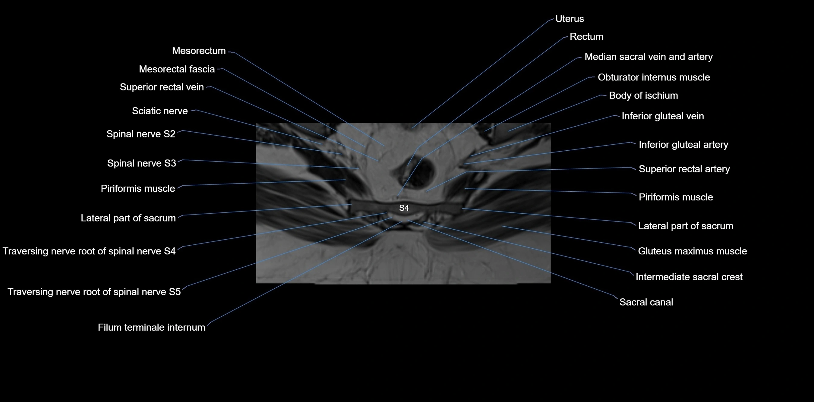 MRI sacrum, coccyx and sacroiliac joint axial cross sectional anatomy 3T  radiology  image-img-00001-00050.webp